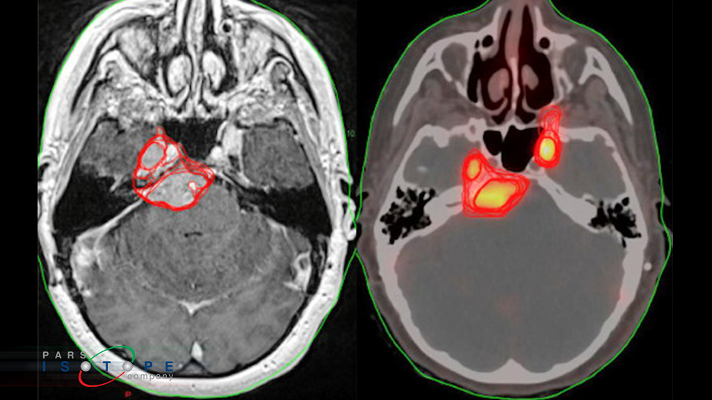 تصویربرداری PET نسبت به MRI