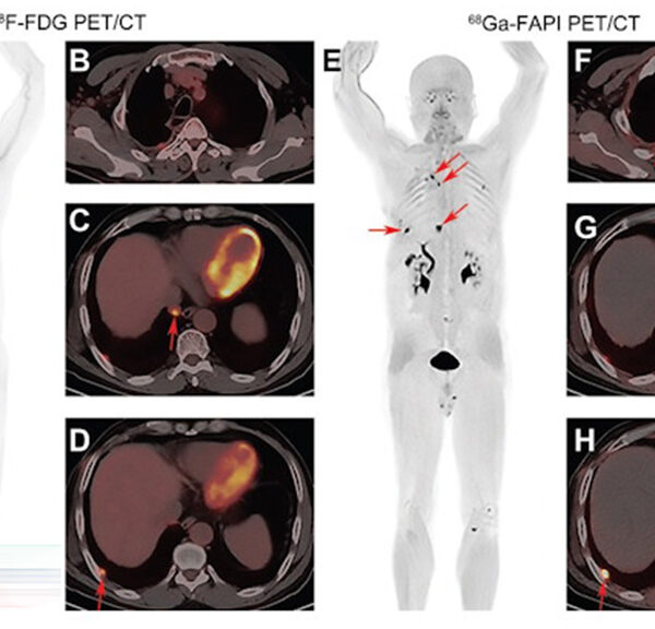 عملکرد بهتر Ga-68 نسبت به FDG در مرحله بندی سرطان ریه