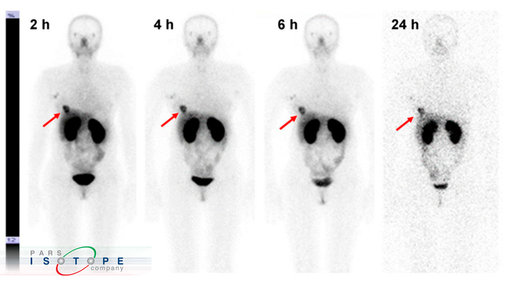رادیودارویی جدید برای تصویربرداری SPECT از ژن HER2 در سرطان سینه